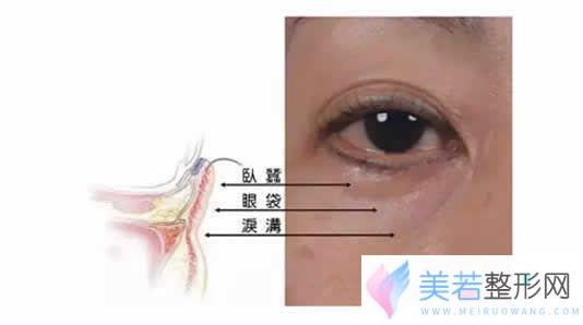 泪沟形成原因介绍