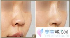 沈阳孟强整形医院隆鼻手术多少钱
