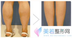 济南槐荫美尔雅整形医院小腿吸脂价格是多少