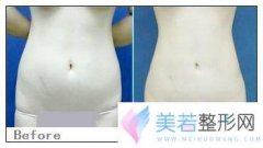 广西南宁联韩整形医院腹部吸脂价格是多少
