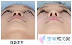 大连新华整形医院膨体隆鼻手术价格是多少