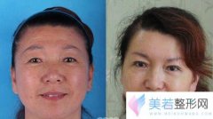 杭州东方整形医院面部除皱价格是多少