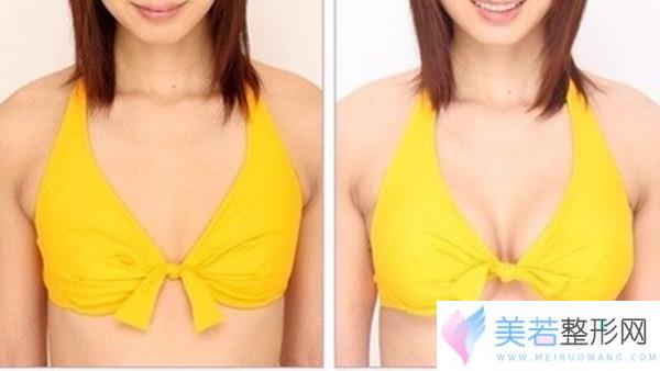 李辉隆胸手术价格是多少 - 