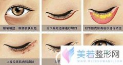做外切去眼袋后留下的白色疤痕可以用激光去除吗？