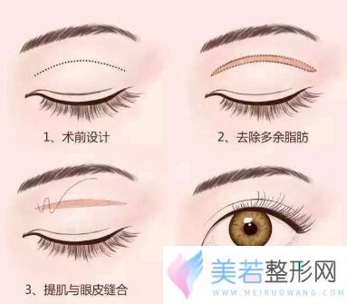 双眼皮