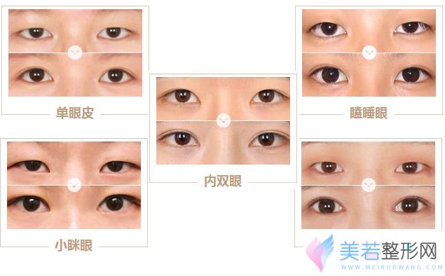 微创双眼皮