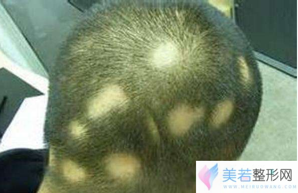 斑秃