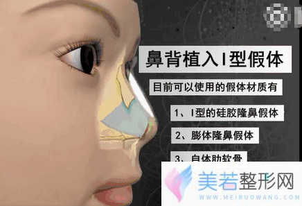 假体隆鼻取出假体