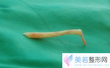 假体隆鼻取出假体