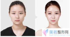 削骨手术后5年真的还会再长吗?