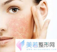 出现红血丝的原因 宁波艺星整形医院激光去红血丝做几次才有
