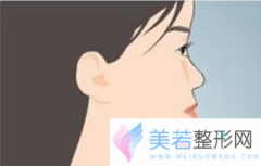 北京芽美口腔医院地包天矫正好吗 地包天的女生好了吗