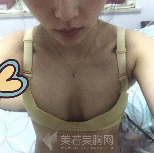 佛山隆胸案例:看我在佛山美莱做的隆胸果图