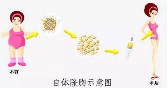 脂肪隆胸术后穿什么内衣比较好?