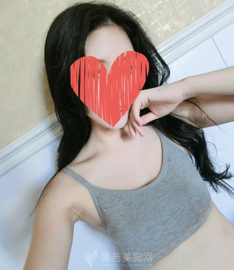 自体脂肪隆胸案例,多余脂肪的二次利用!