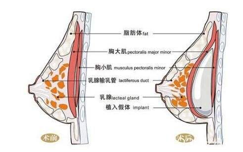 隆胸失败后怎么修复?修复方法全解析!