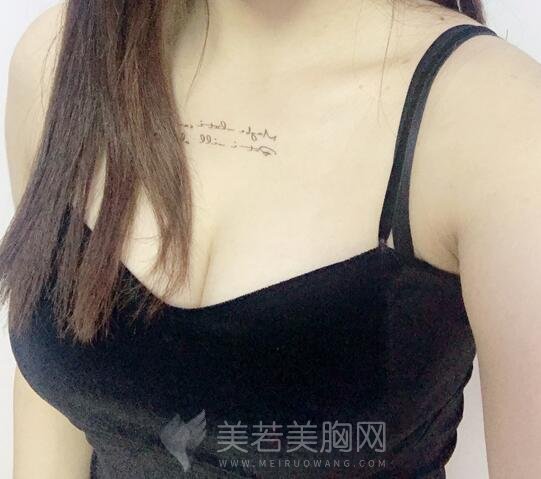 妙桃假体隆胸术后的效果真的很赞，附上效果图