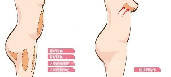 自体脂肪隆胸手术有什么坏处吗?手术弊端