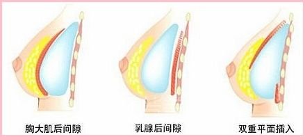 硅胶隆胸手术是怎么做的?手术大概流程