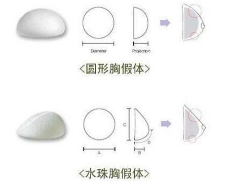 硅胶隆胸手术是怎么做的?手术大概流程