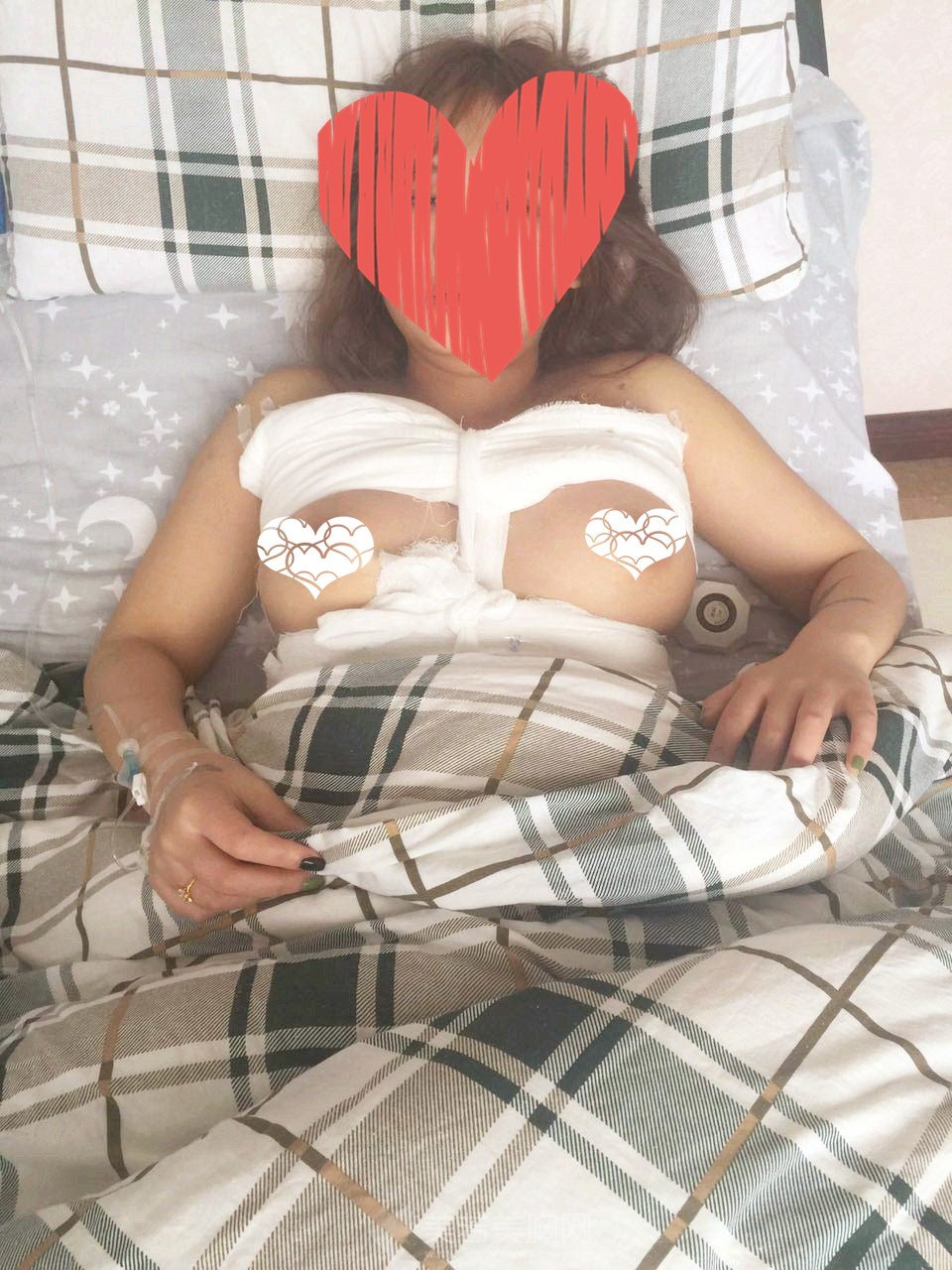 本人整理的隆胸假体成功案例,希望给各位一点帮助!