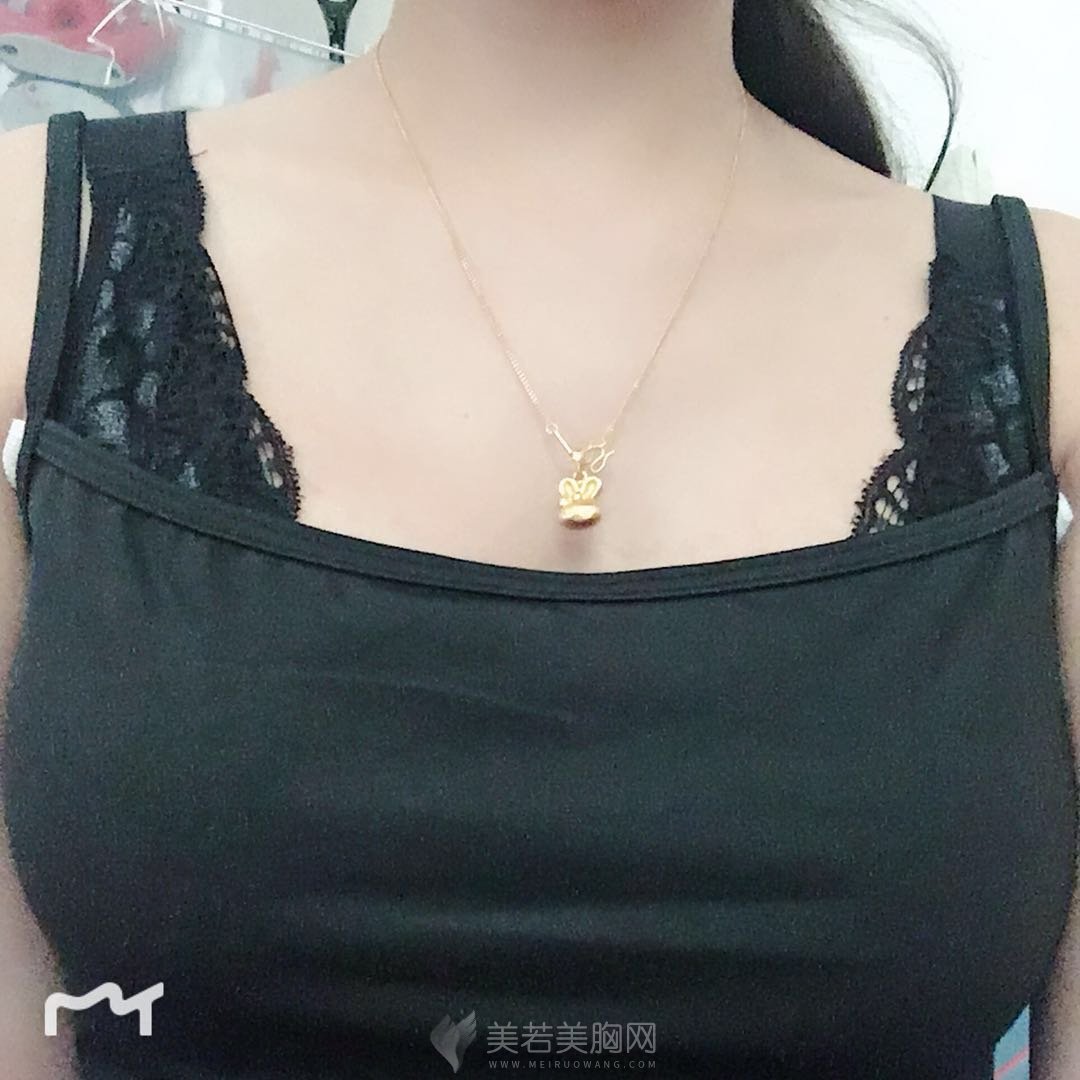 分享做的水滴型假体隆胸,手感超真实!