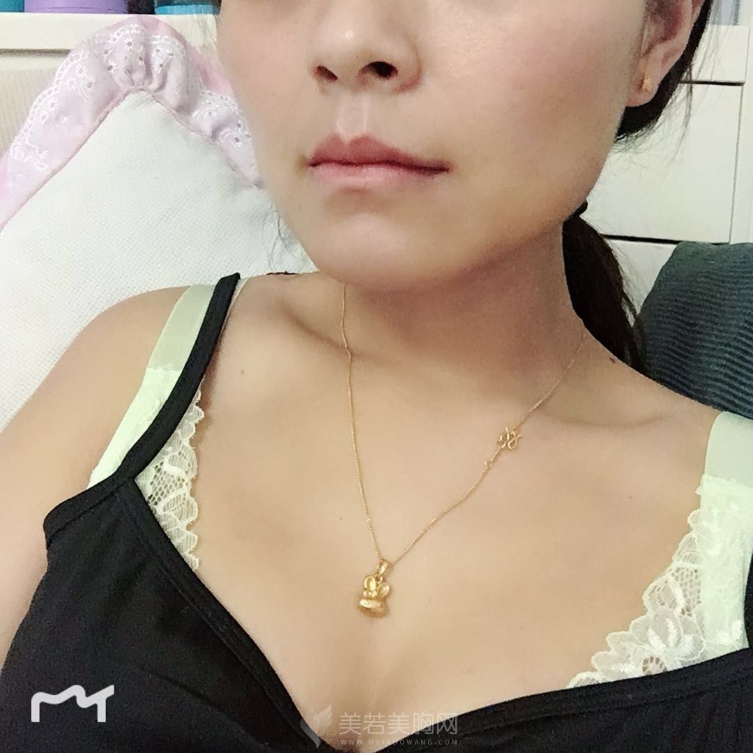 分享做的水滴型假体隆胸,手感超真实!