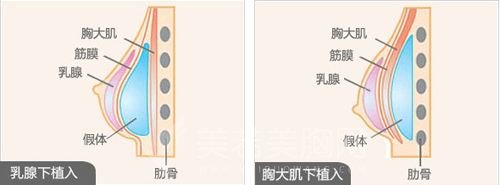 隆胸手术的价格公布,快看你能承受得住不!