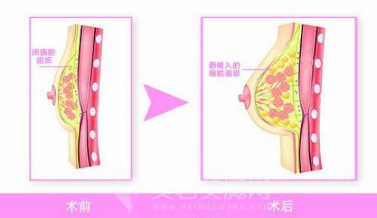 自体脂肪隆胸好吗?手术会有什么后遗症吗?