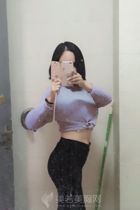 性价比超高的脂肪隆胸案例反馈，不看可惜！