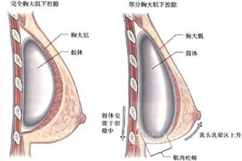 哪些情况适合做隆胸手术失败修复?看你中招没有!