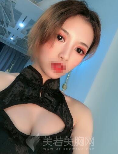 自体脂肪隆胸真实案例,快来看我还需要二次填充吗……