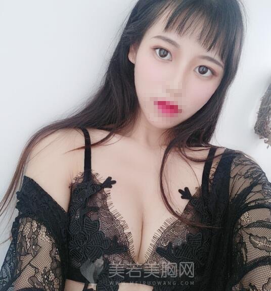 自体脂肪隆胸真实案例,快来看我还需要二次填充吗……