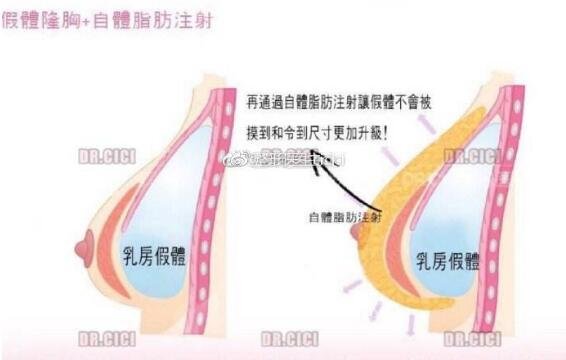 做过复合隆胸是怎样的感受?果、手感两不误!