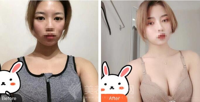 北医三院陈育哲隆胸案例,术后女同事纷纷羡慕!