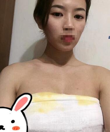 北医三院陈育哲隆胸案例,术后女同事纷纷羡慕!