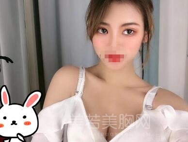 北医三院陈育哲隆胸案例,术后女同事纷纷羡慕!