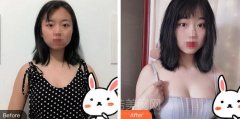 青岛伊美尔隆胸术后恢复日记，果太惊艳了！