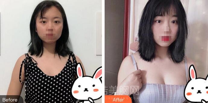 青岛伊美尔隆胸术后恢复日记