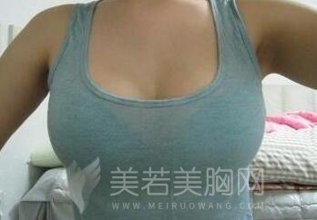 丰胸手术后遗应当怎样护理?