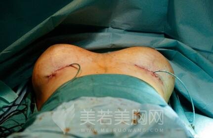丰胸手术后遗应当怎样护理?