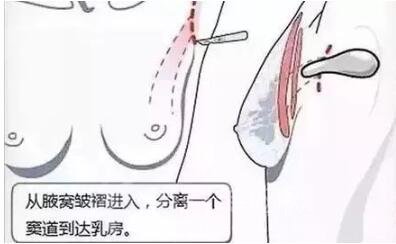 假体丰胸怎样挑选合适的创口?