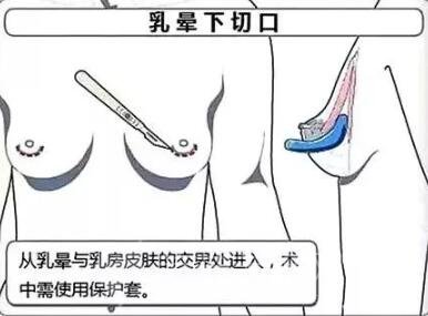 乳头创口