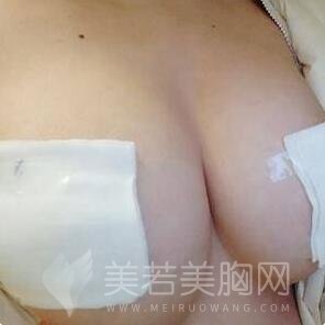 自体脂肪隆胸是不是可以一次成形?