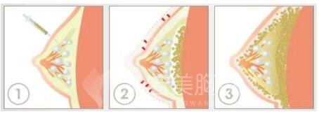 脂肪移植皮下组织遮盖不够