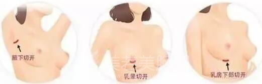 复合型假体丰胸弊端大分析