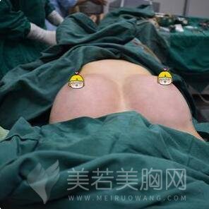 假体丰胸手术大约要多少钱?隆胸价格