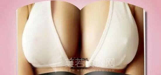 娜高假体丰胸打造d罩杯的果怎么样?