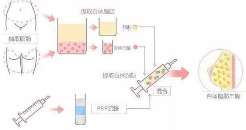 自体脂肪丰胸:原材料源自本身更没问题性