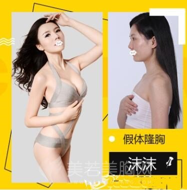 假体丰胸是否会形变,挪动?